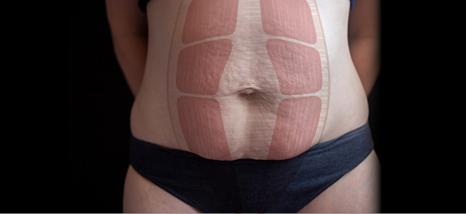 Everything You Need to Know About Diastasis Recti - BodyICE Australia