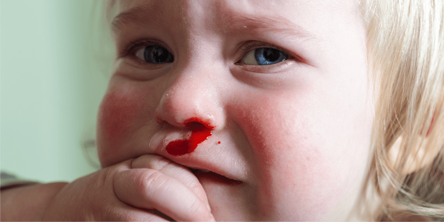 How to treat a blood nose in your toddler - BodyICE Australia