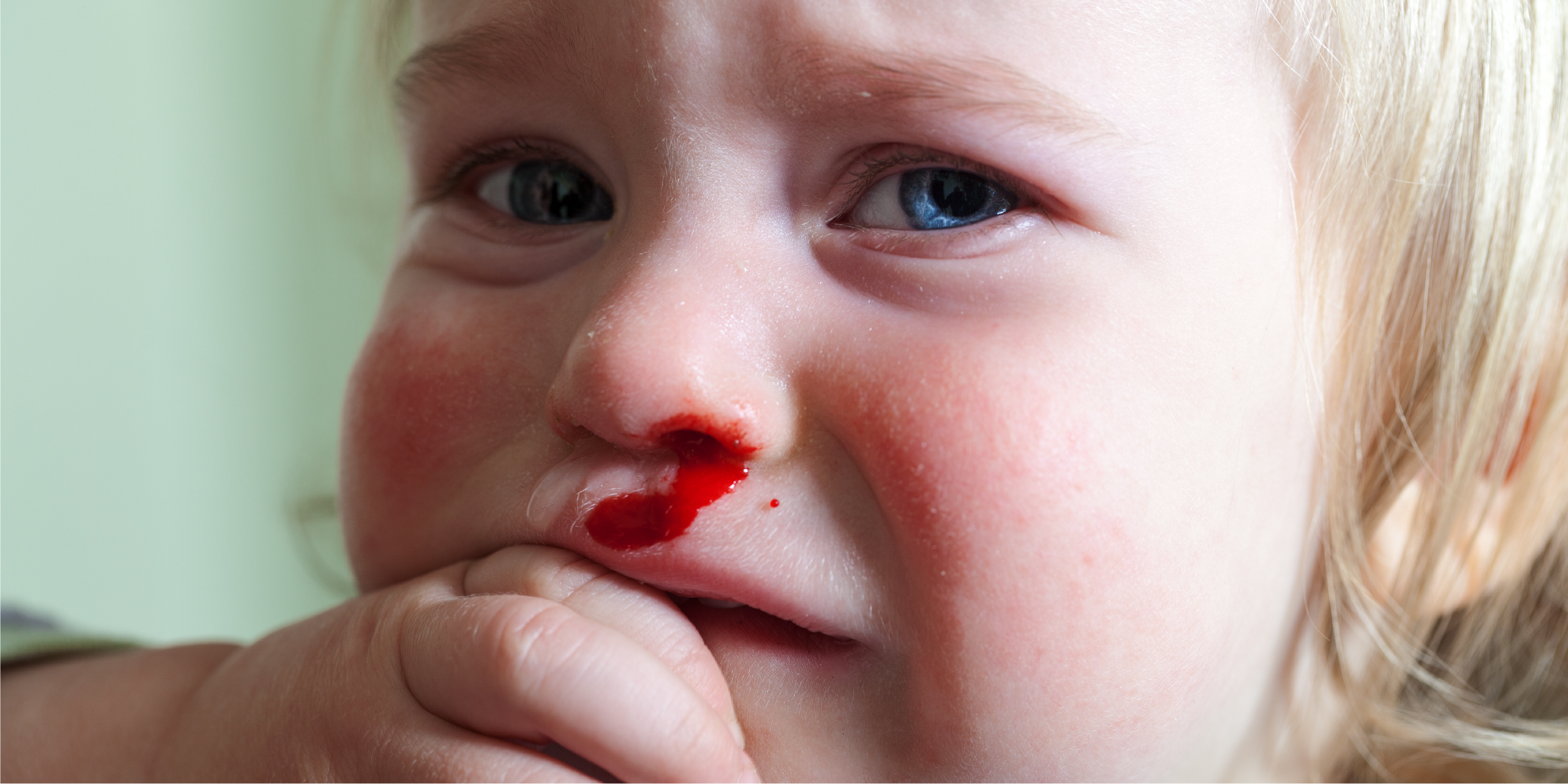 Nosebleeds in toddlers